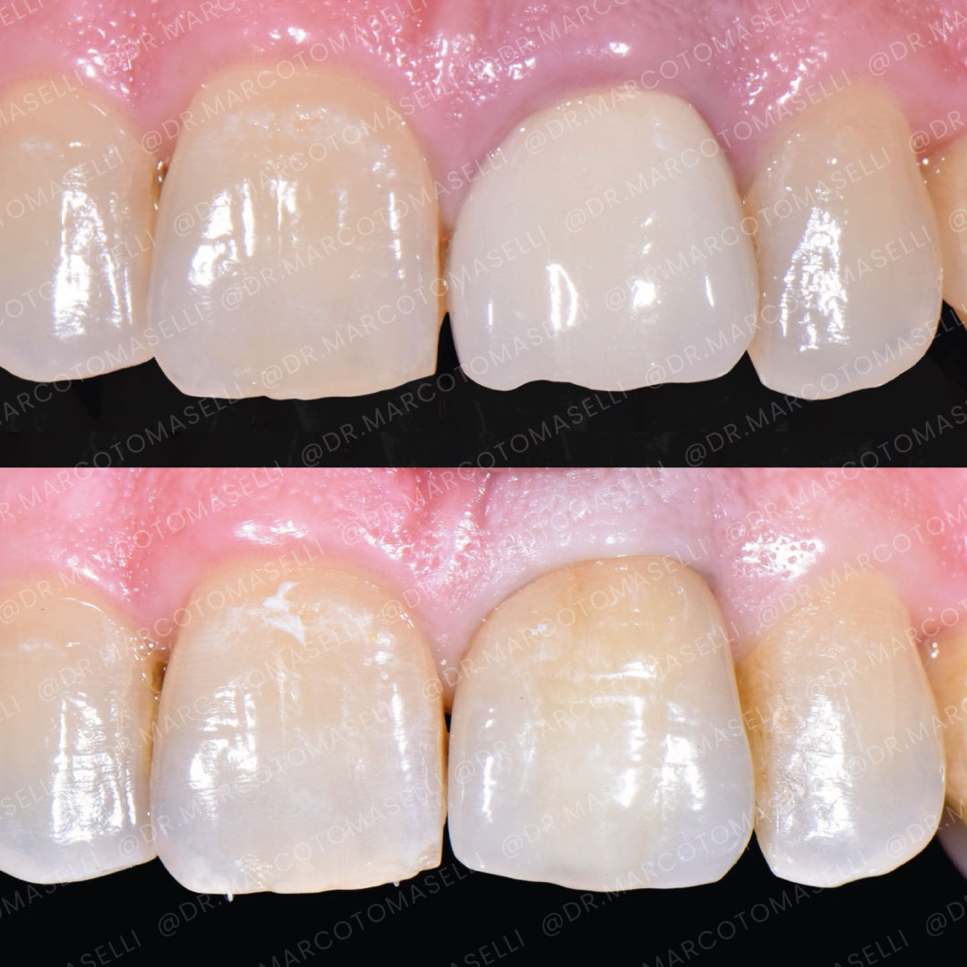 1.corone → Dott. Marco Tomaselli corone dentali di qualità