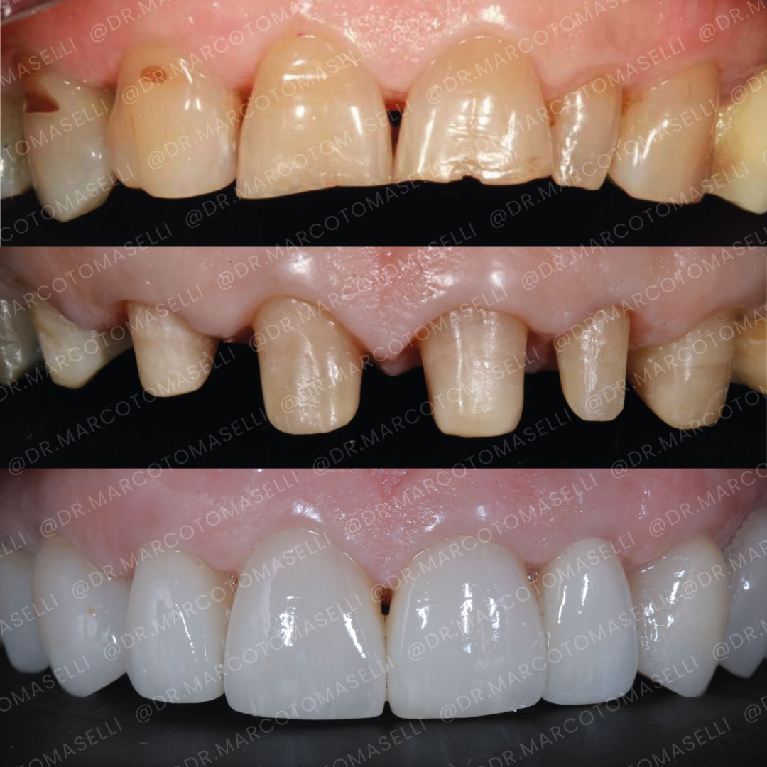 3.Corone su denti naturali → Dott. Marco Tomaselli corone su denti naturali