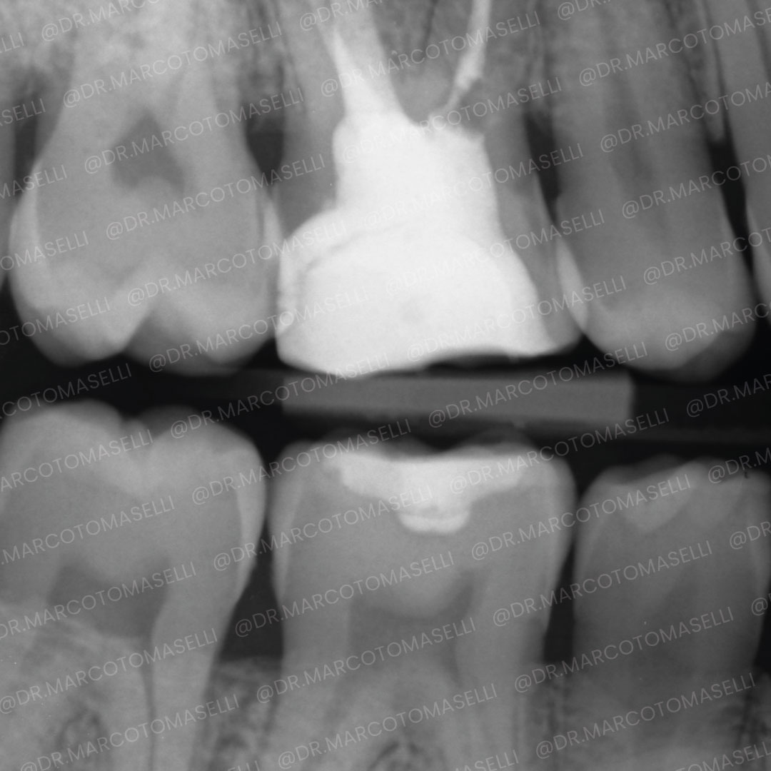 Radiografia carie