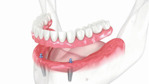 overdenture su impianti