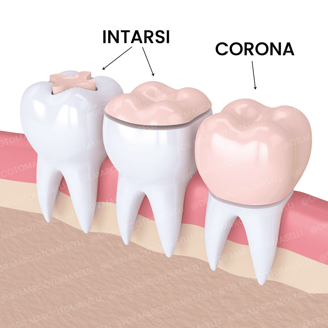 intarsi-vs-corona → Dott. Marco Tomaselli Differenza tra Intarsio dentale e una Corona dentale
