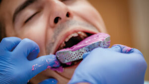 impronte dentali