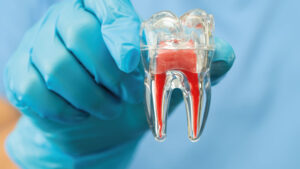 modellino polpa dentale