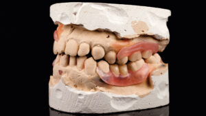 protesi con ganci estetici