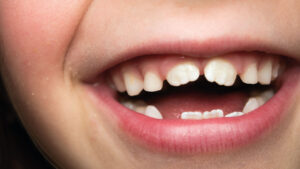 denti da latte