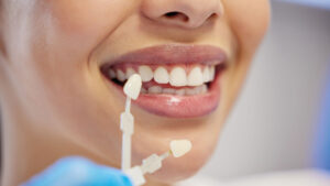 faccette dentali
