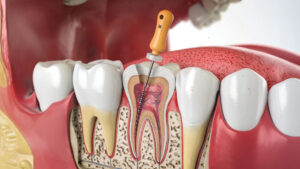 trattamento endodontico