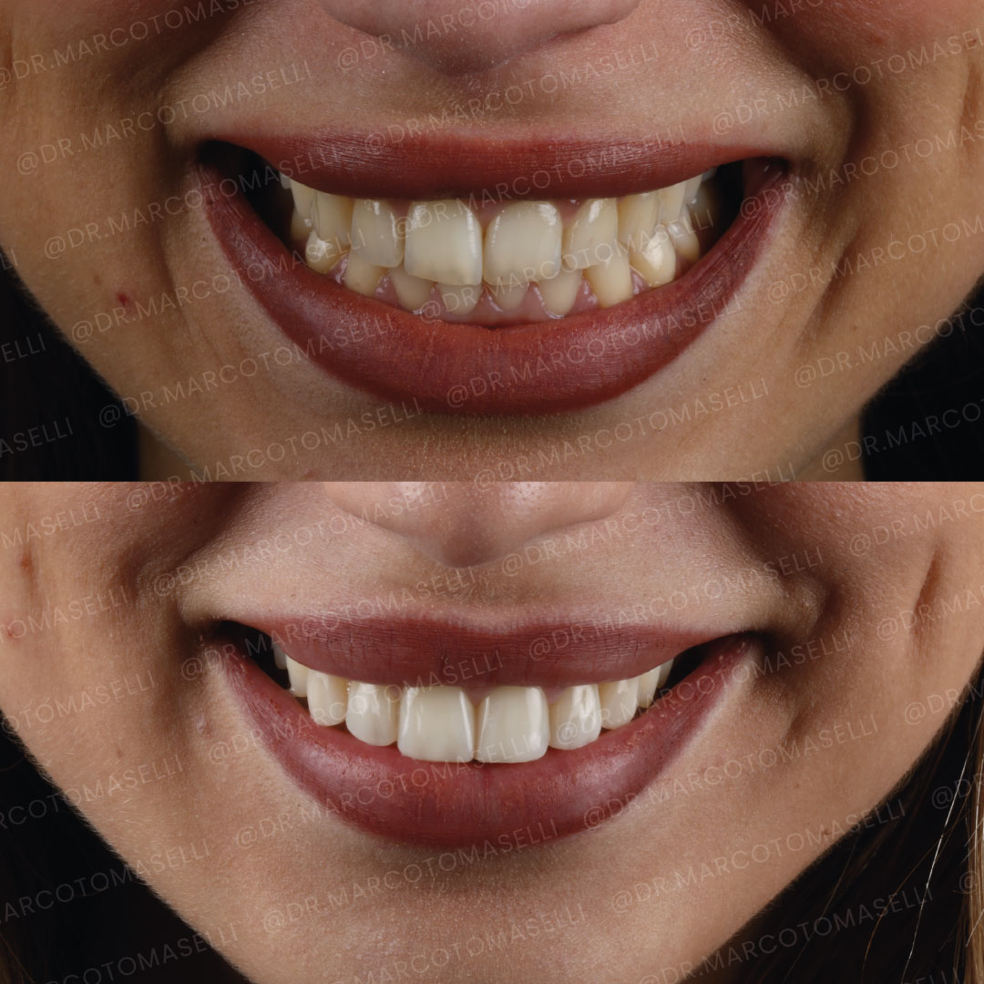 Sorriso di Giulia, prima e dopo → Dott. Marco Tomaselli ricostruzione in composito