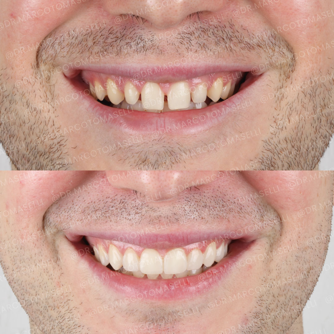 Sorriso di Andrea, prima e dopo → Dott. Marco Tomaselli